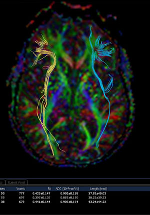 The Role of Advanced Testing in Diagnosing TBI